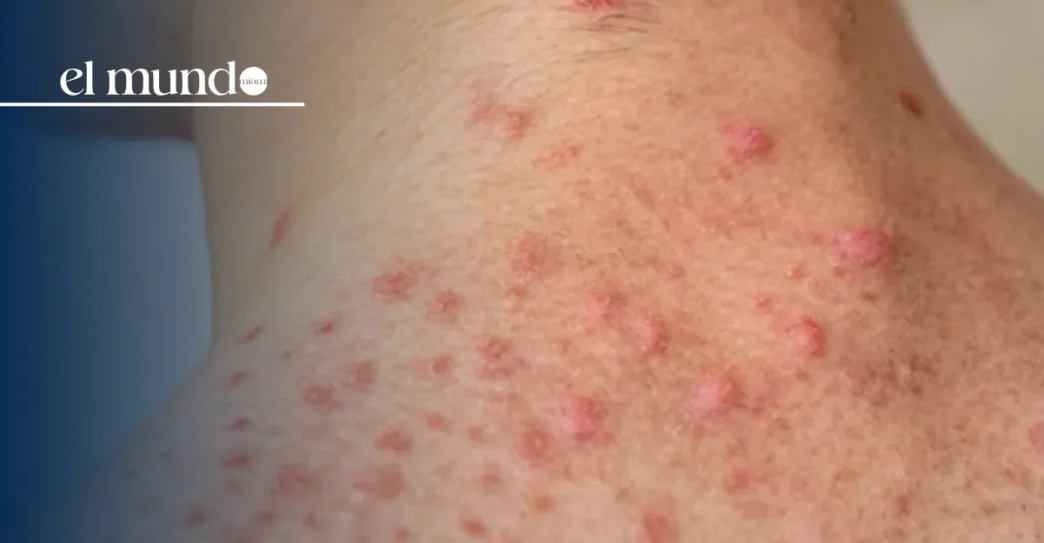 Measles Cases on the Rise in the United States