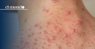 Measles Cases on the Rise in the United States