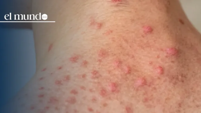Measles Cases on the Rise in the United States
