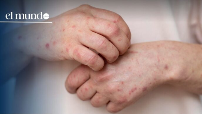 Measles in Florida: Cases Increase in 2026 While Delays in Official Data Persist