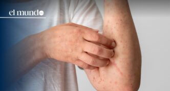 Florida among the states with the most measles cases in the United States